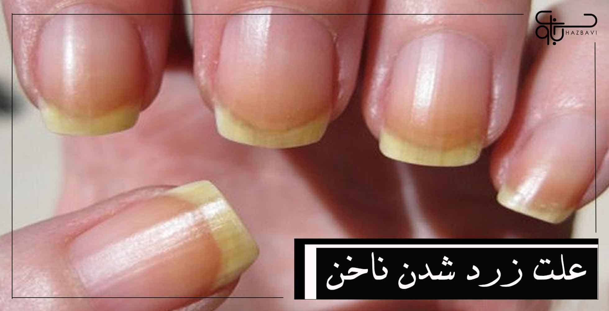 علت زرد شدن ناخن